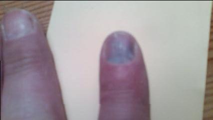 blauer Finger